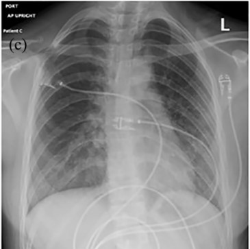 Así son las lesiones pulmonares causadas por el uso de vapeadores en humanos (UC Regents)