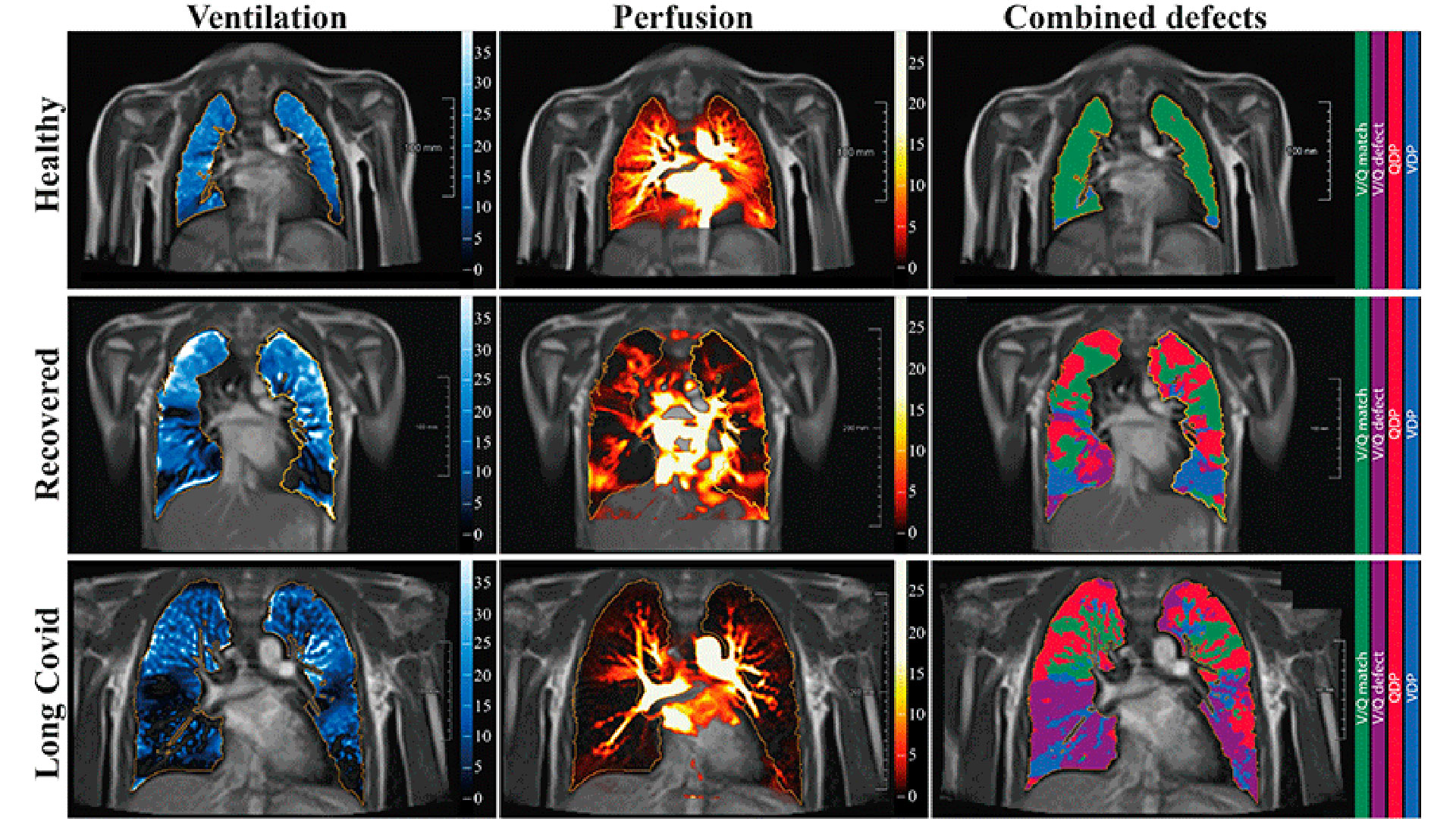 "Los niños y adolescentes que se recuperaron de COVID-19 o que tienen COVID durante mucho tiempo muestran daño pulmonar persistente en la resonancia magnética" (Radiology)
