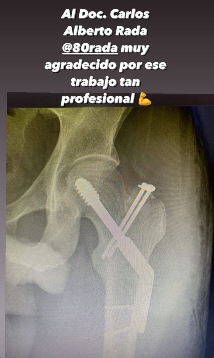 Radiografía de la fractura revelada por Santiago Botero Foto: @santiago.botero13 instagram