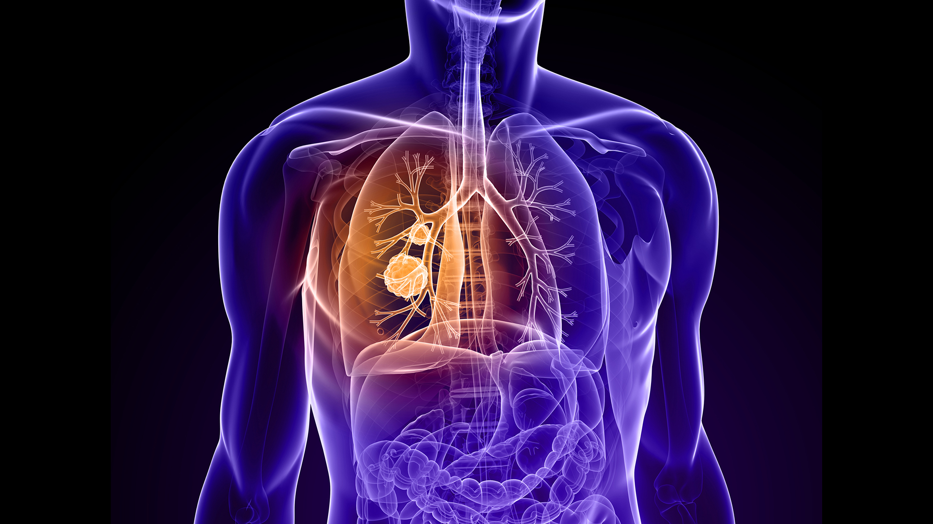 El cáncer de pulmón es una enfermedad maligna que puede localizarse en el tejido pulmonar propiamente dicho, en el interior de los bronquios, o en ambos sitios (IStock)