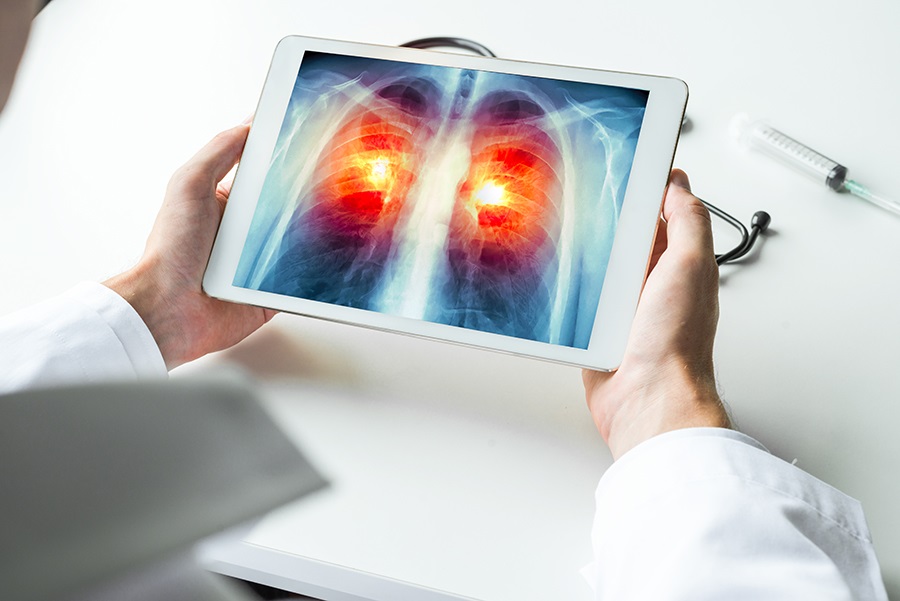 Radiografía digital de un cáncer de pulmón  (SALUD ANDALUCÍA ESPAÑA)
