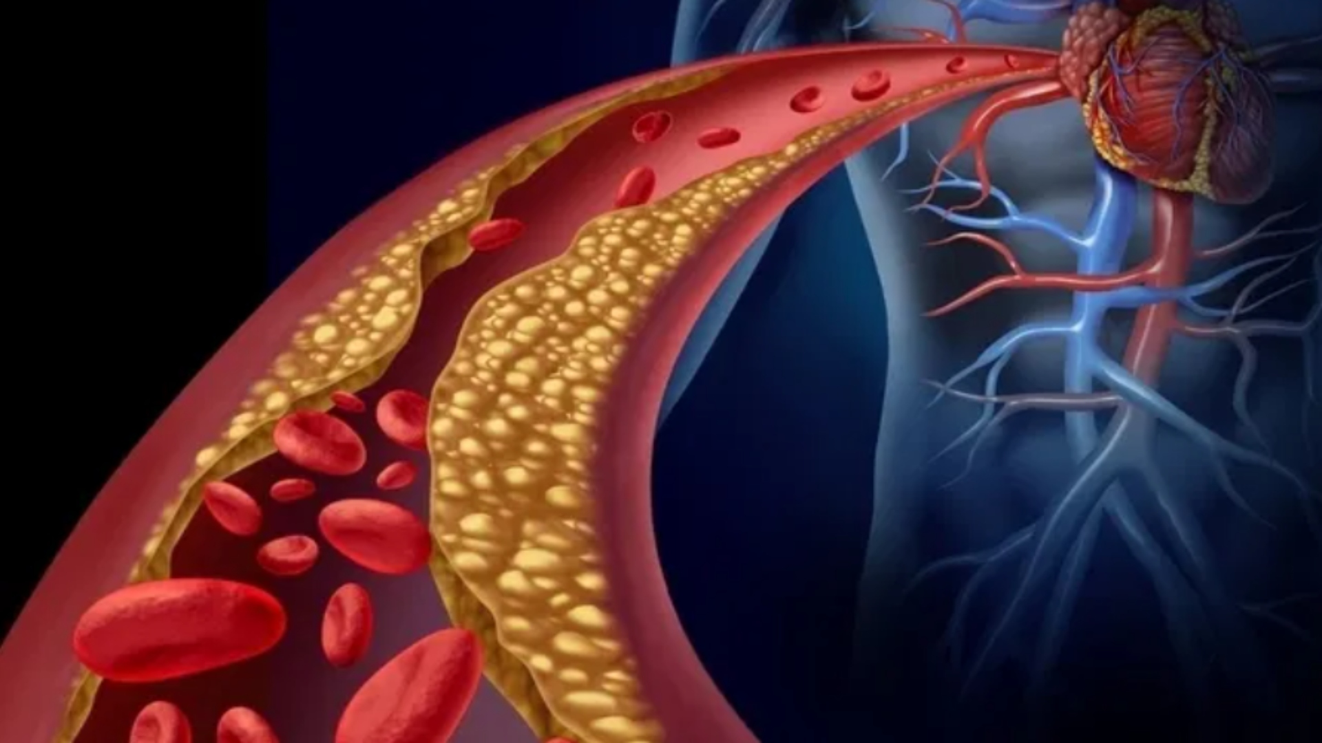 Cuáles son los síntomas del colesterol alto y cómo prevenir las  enfermedades cardiovasculares - Infobae