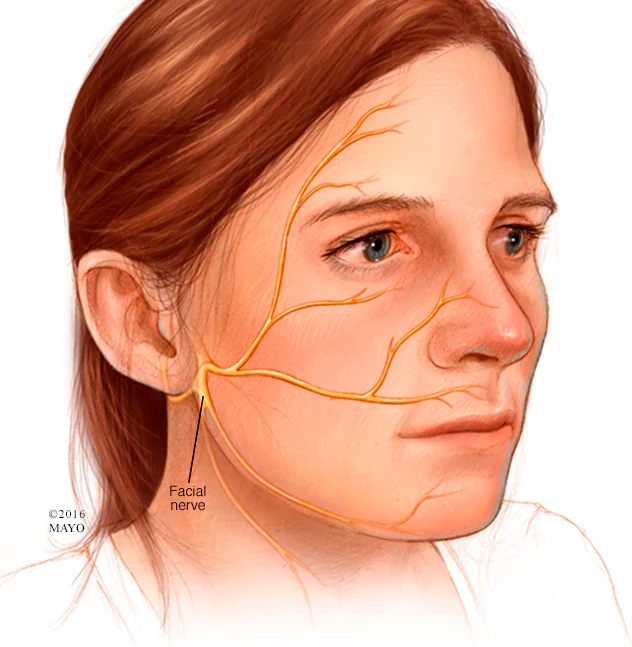 Así se inflaman los nervios del rostro, partiendo desde el oído (Foto: Mayo Foundation for Medical Education and Research)