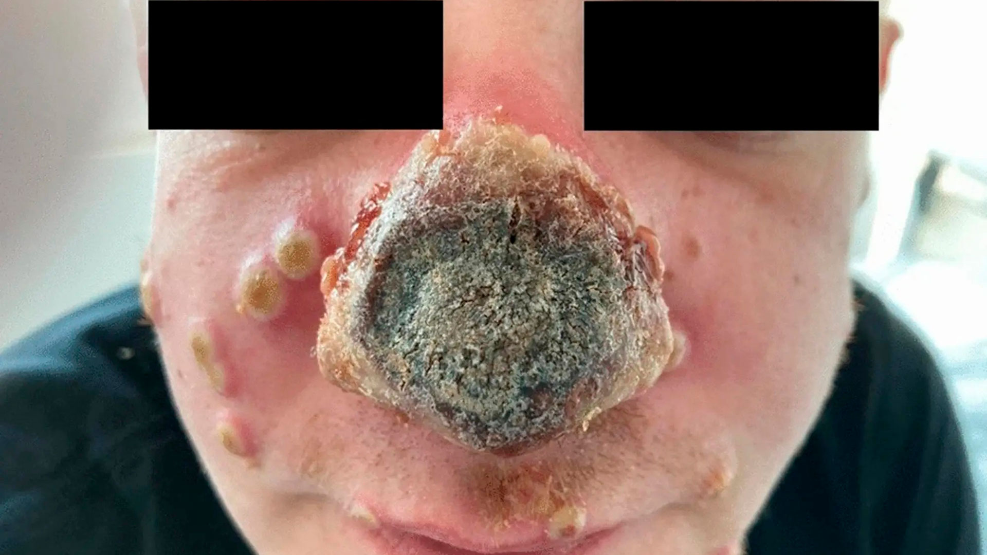 La nariz del hombre comenzó a pudrirse tras un test de viruela del mono y una ETS no diagnosticada
