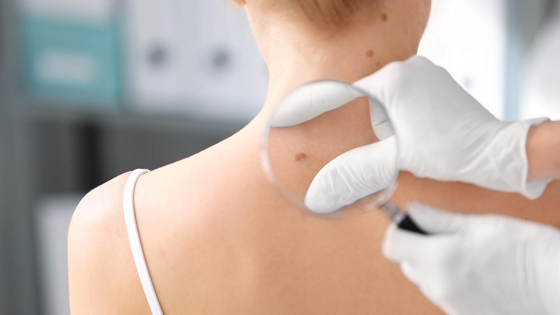 El cáncer de piel, en la mayoría de los casos, es prevenible y curable si es detectado a tiempo (Shutterstock)