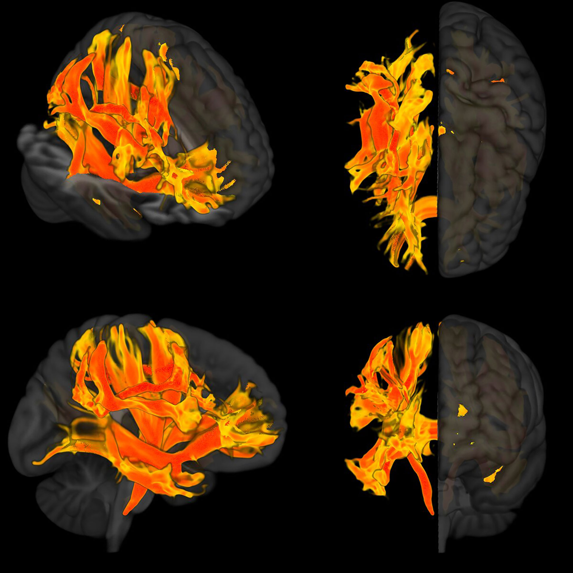 Descrizione: la ricostruzione 3D mostra come l'ipertensione sistolica ha colpito le principali regioni della sostanza bianca del cervello.  Il colore rosso mostra le zone maggiormente colpite dall'ipertensione, mentre anche le zone gialle ne sono colpite ma in misura minore.  Lo studio ha mostrato che l'alta pressione arteriosa sistolica provoca danni alla sostanza bianca e alle sue connessioni con altre parti del cervello e questo è collegato a peggiori funzioni cognitive nelle persone analizzate/Credit: Courtesy of Dr.Lorenzo Carnevale, IRCCS INM Neuromed, Pozzilli , Italia/medicalxpress