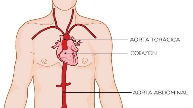La ruptura de un aneurisma de estas características reviste una mortalidad del 90 por ciento en las primeras horas de producida si no se realiza el reemplazo