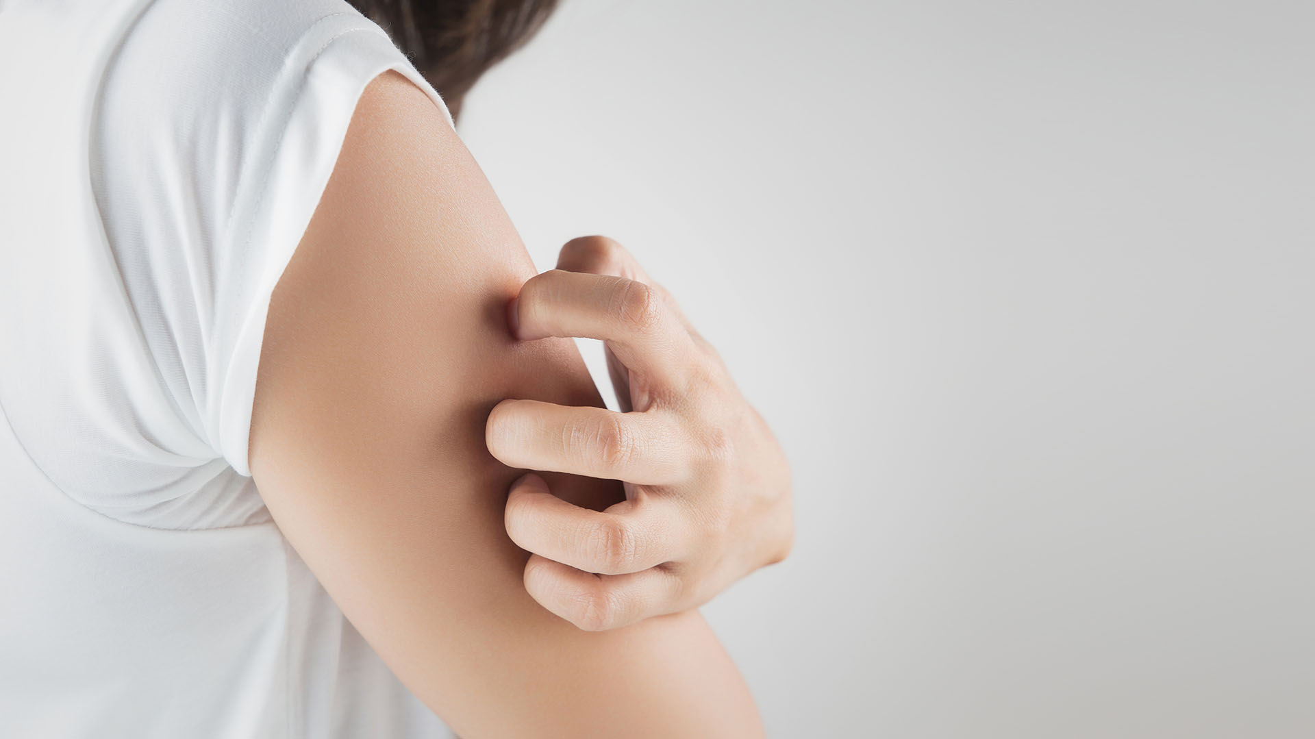 Determinados alimentos, el clima y hasta el estrés pueden incrementar la dermatitis atópica (Getty Images)