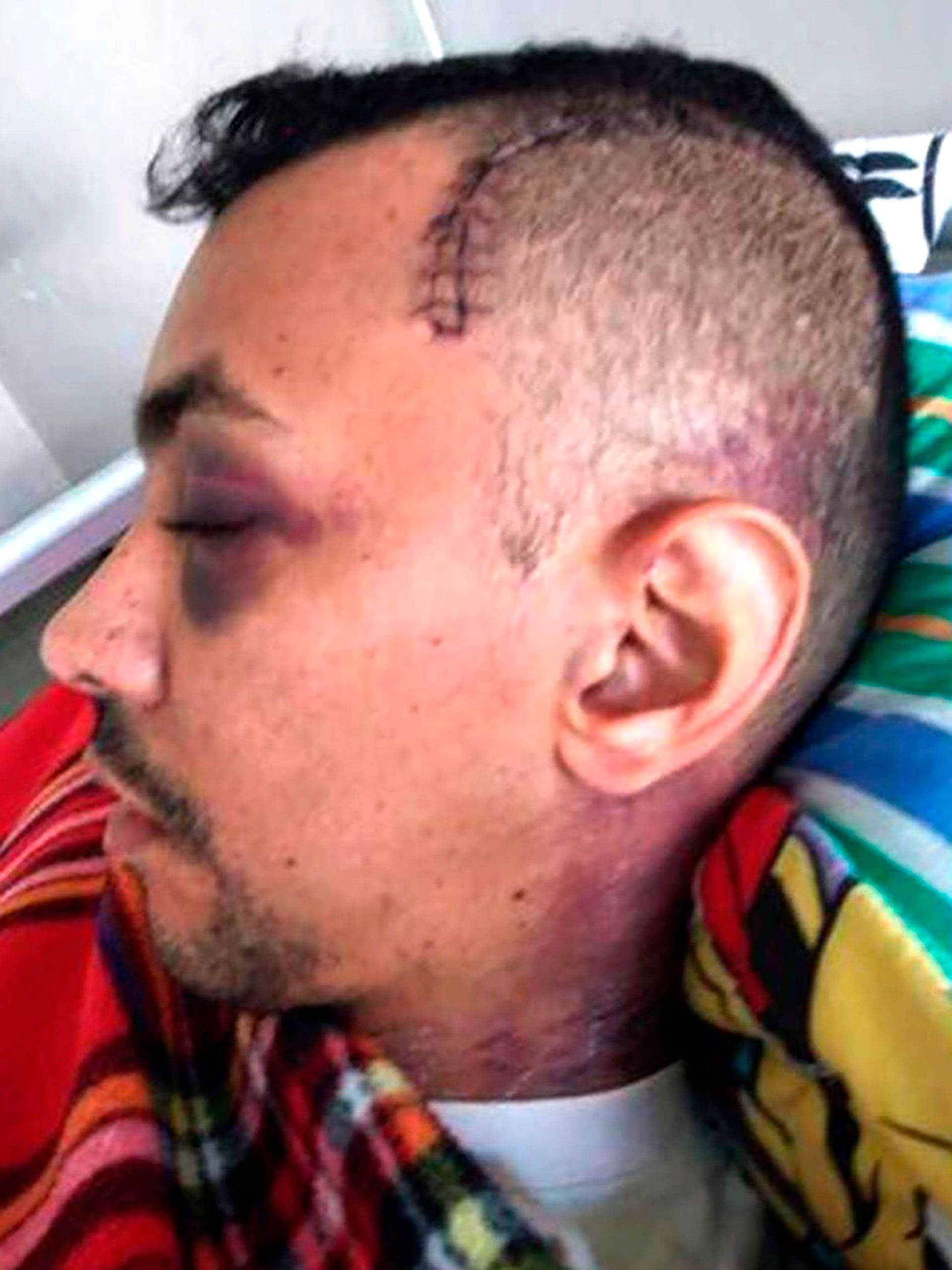 Las heridas que sufrió el 1TTE Mogollón Velasquez fueron graves y en la cabeza