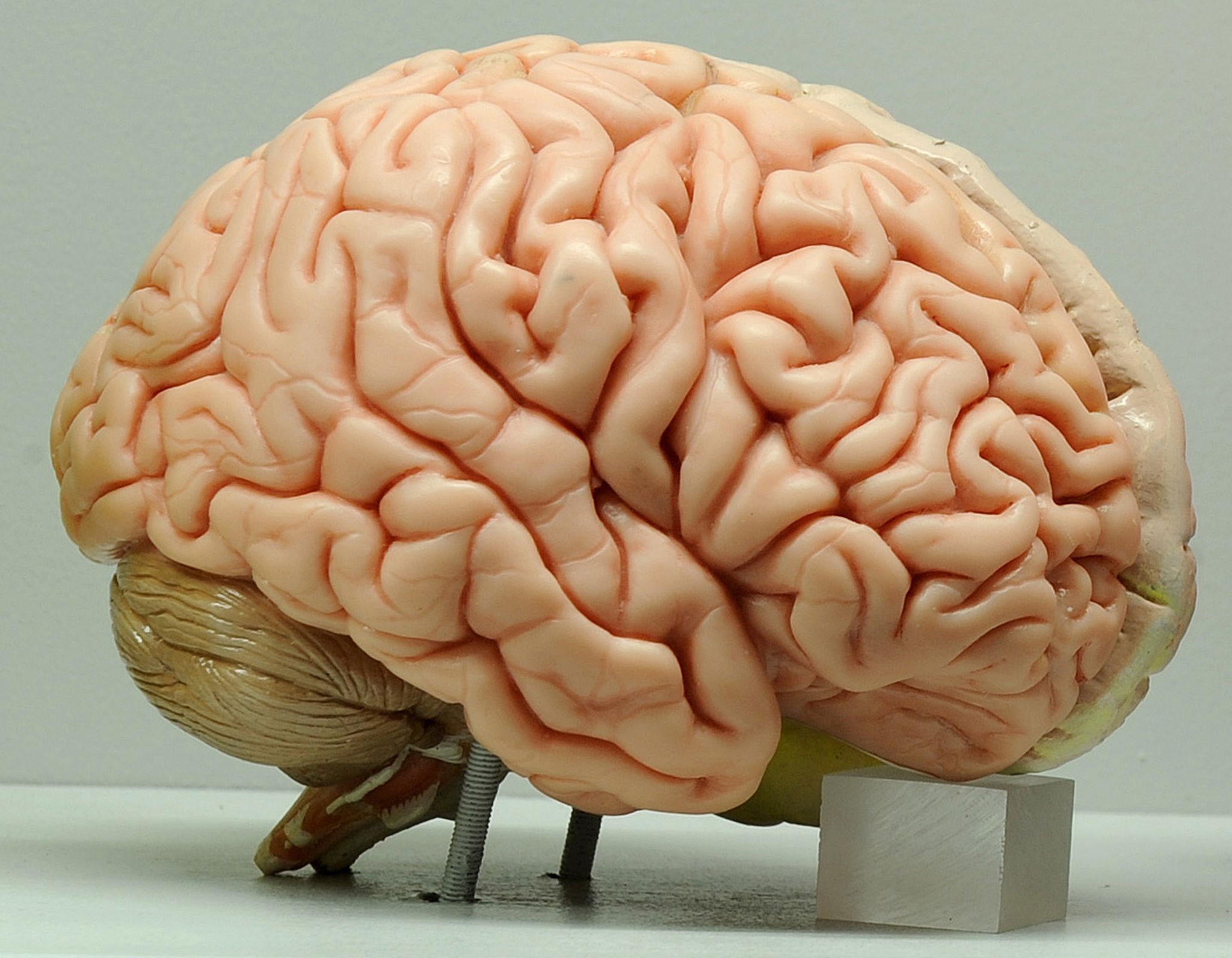 La investigación, cuyos resultados fueron publicados en la revista Brain, también incluyó el análisis de datos de pacientes con lesión cerebral traumática