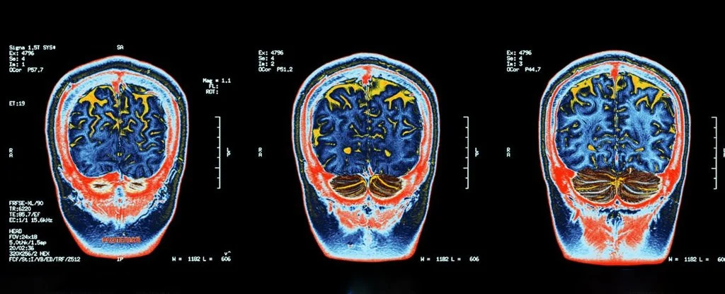 Las personas socialmente aisladas tenían una cognición más pobre, incluida la memoria y el tiempo de reacción, y un menor volumen de materia gris en muchas partes del cerebro.