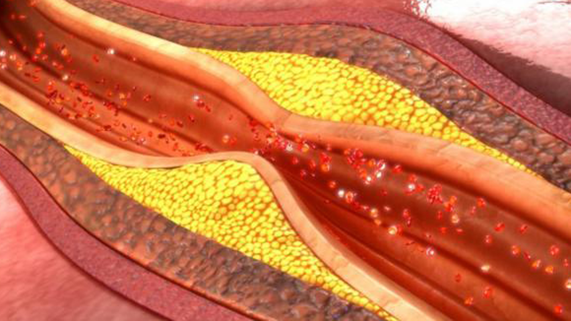Descubrieron dónde se producen las roturas de placas que llevan a los infartos, al ACV y a la demencia vascular