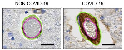 Estas imágenes muestran un aumento de los niveles de la molécula de adhesión (llamada PECAM-1) en las células endoteliales del tejido cerebral de los pacientes que murieron por el COVID-19. La PECAM-1 puede hacer que las plaquetas se adhieran entre sí, formando coágulos y obstrucciones en los vasos sanguíneos del cerebro. El vaso sanguíneo figura en color verde y el espacio interior en color rosa/NINDS