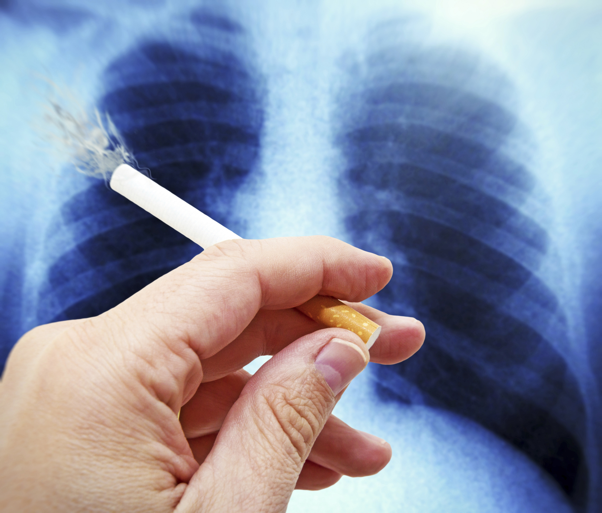 El 87 por ciento de los casos de cáncer de pulmón son a causa del cigarrillo (iStock)