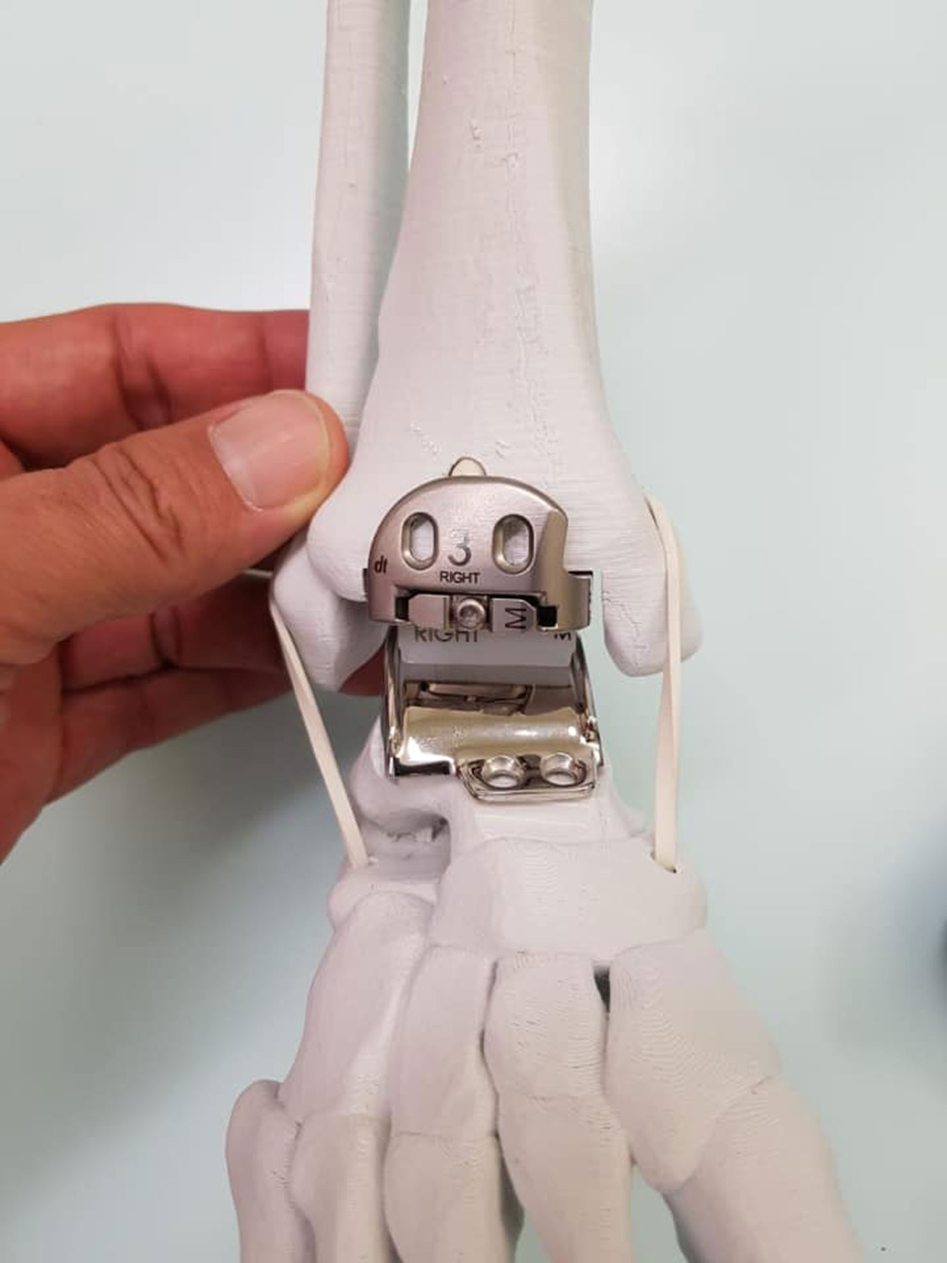 Esta es la prótesis que reemplazó el tobillo izquierdo de Batistuta (Facebook Gabriel Batistuta)