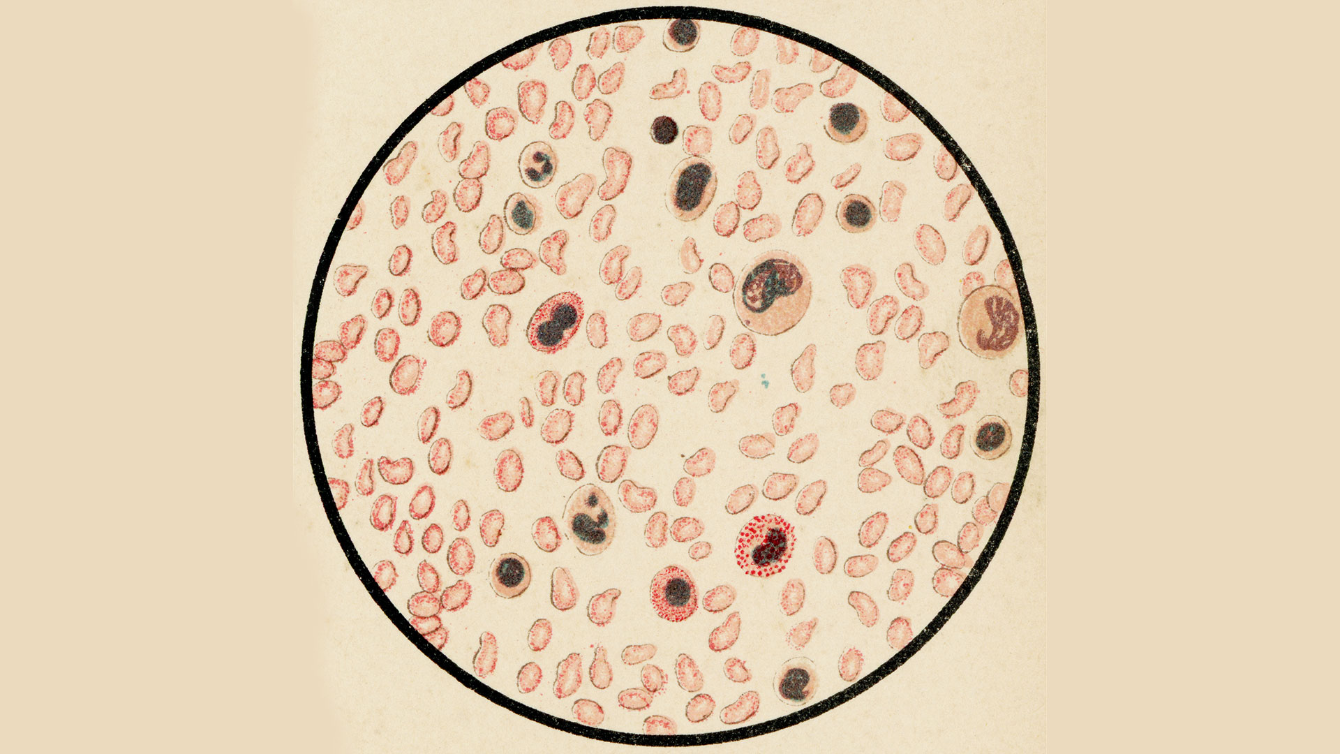 Es la primera vez que la ciencia demuestra que un fármaco dirigido a un complejo proteico ejerce un grado de presión sobre la leucemia en pacientes (Gettyimages)