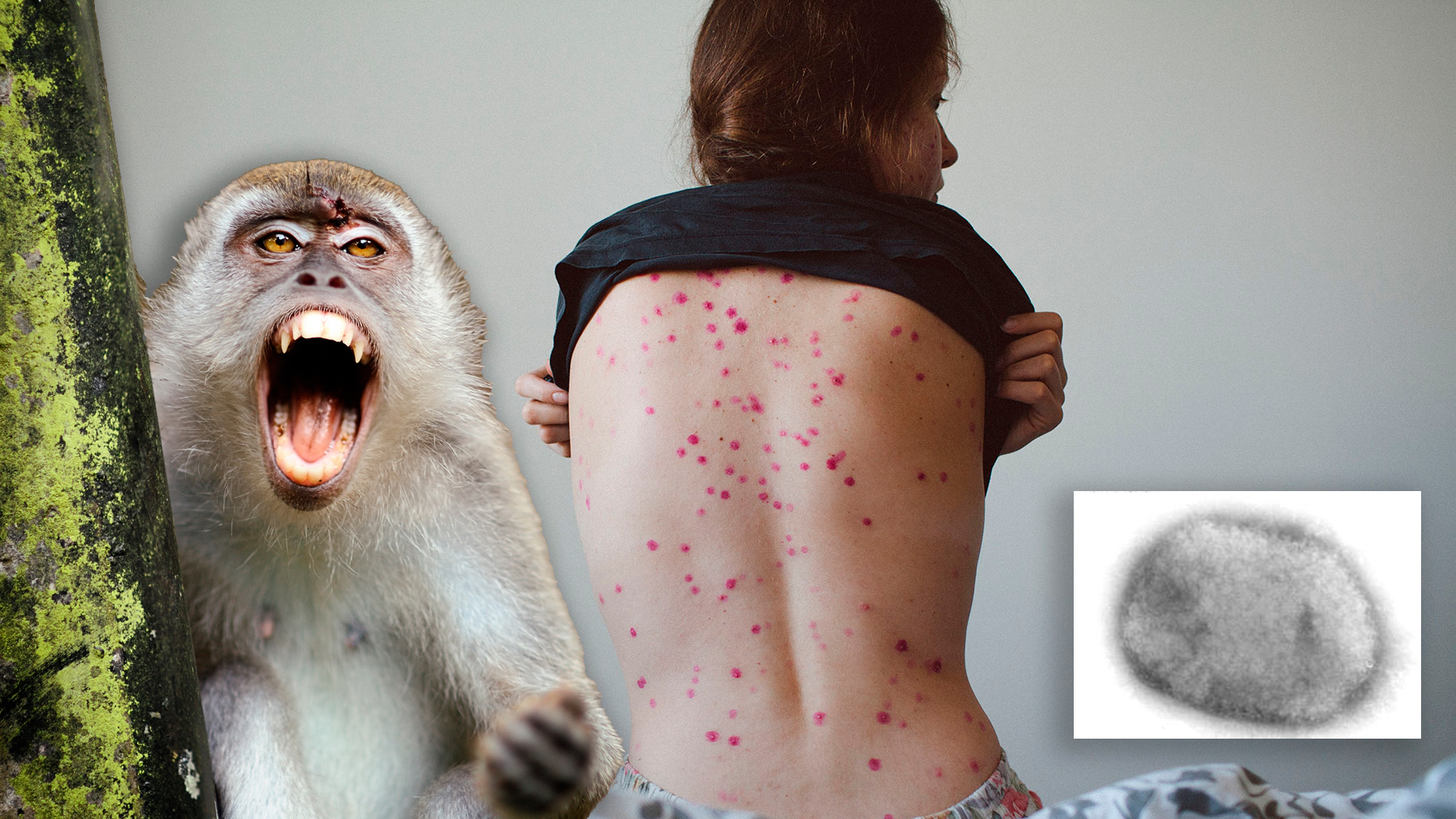 Tras el caso sospechoso en Argentina: cómo avanza la viruela del mono en el mundo y qué dicen los expertos