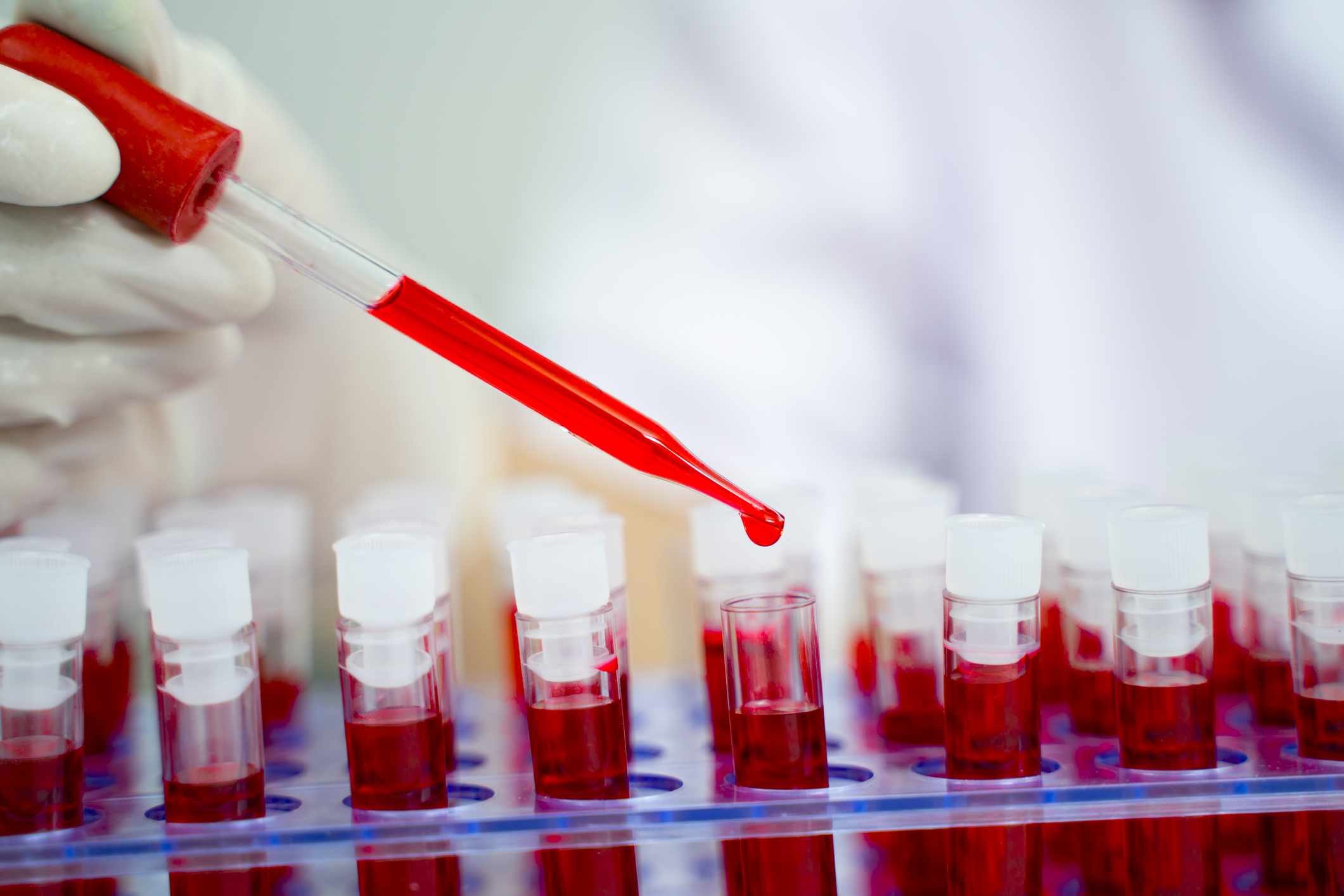 Ayudante de laboratorio analizando una muestra de sangre (Getty)