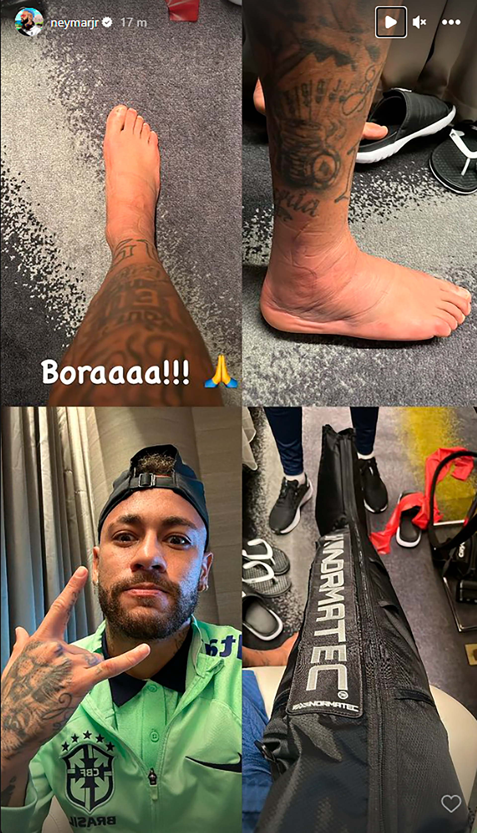 Cómo quedó el tobillo derecho de Neymar