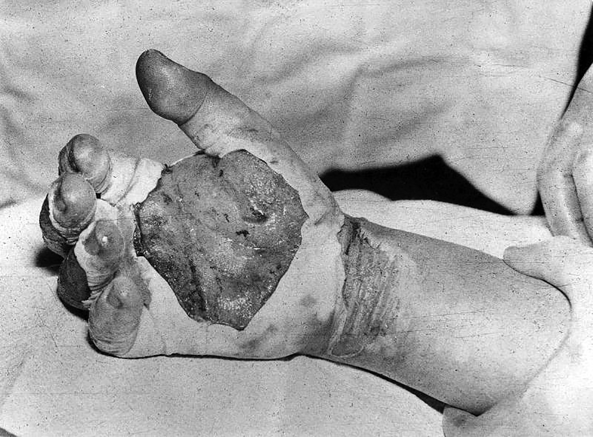 La mano convertida en una llaga de Harry Daghlian (Wikipedia)