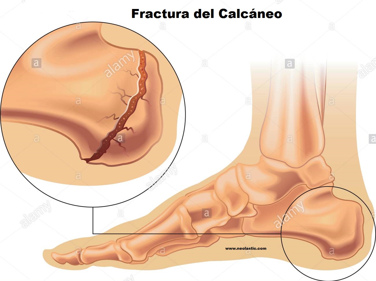 Se Puede Apoyar El Pie Con La Bota Walker La operación de Verónica Lozano: cómo es la rehabilitación de una cirugía  en los talones - Infobae