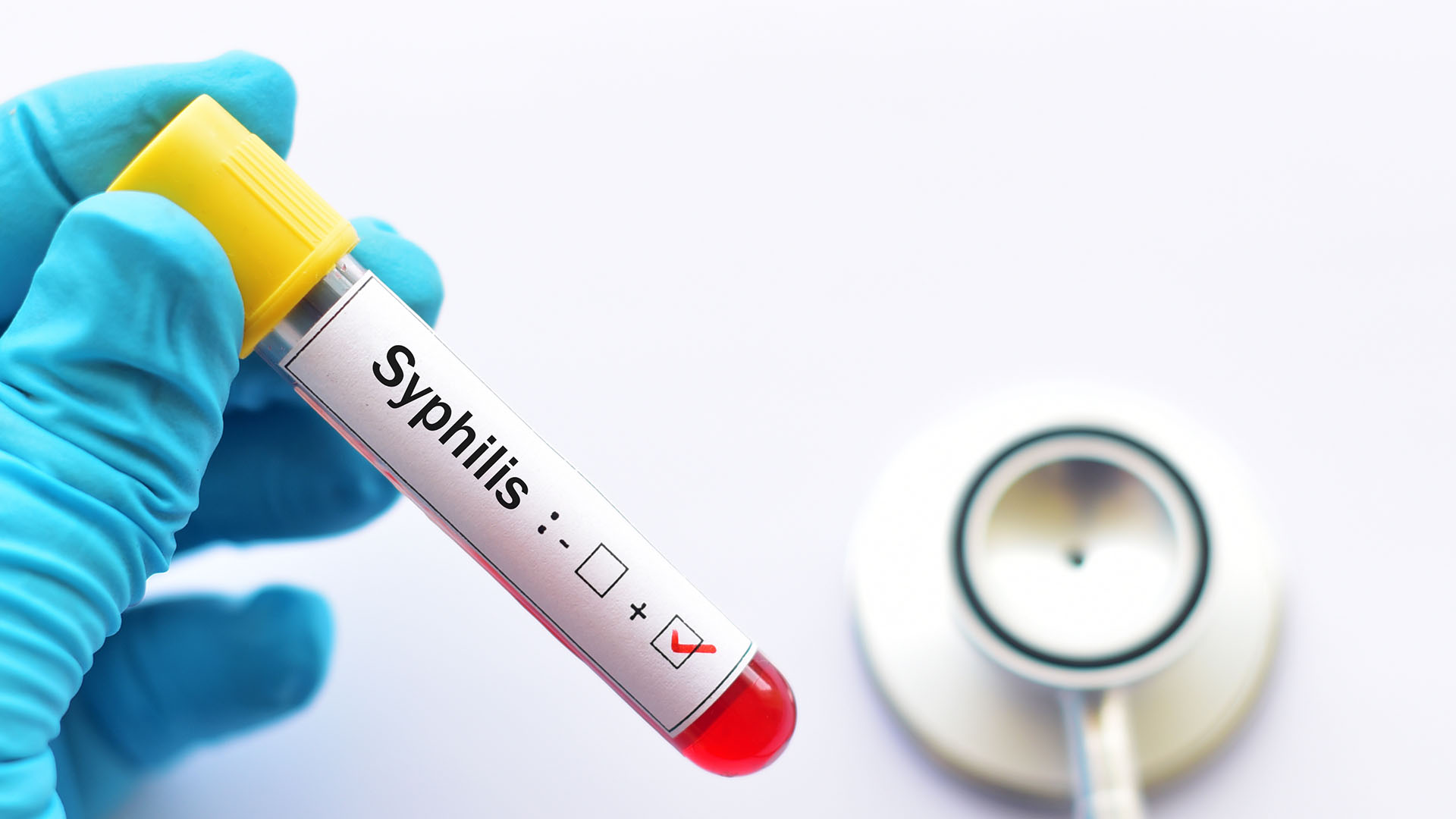 La sífilis es una infección que puede ser transmitida al hijo durante el embarazo. La persona gestante debe ser estudiada y tratada para evitar la transmisión/Archivo