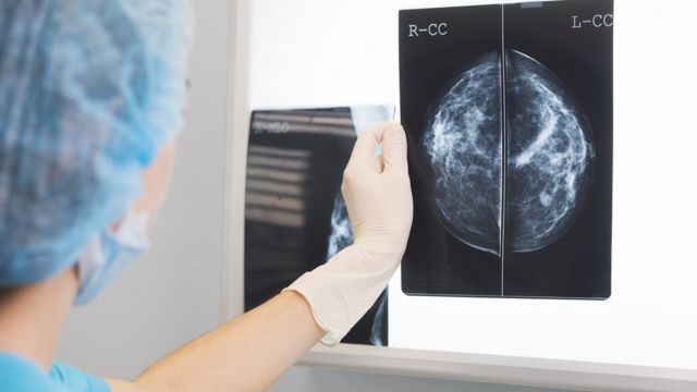 Médico revisando si existe cáncer de mama en una radiografía. (foto: BBC)