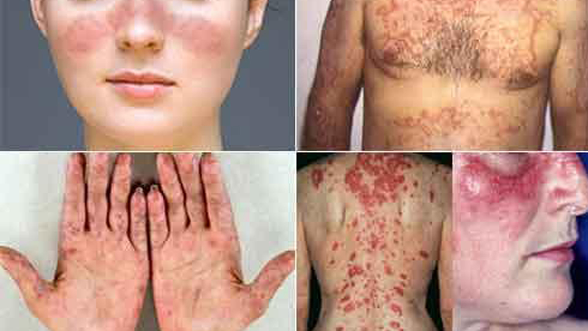 El lupus es una condición a largo plazo que causa dolor en las articulaciones y erupciones en la piel y no tiene cura