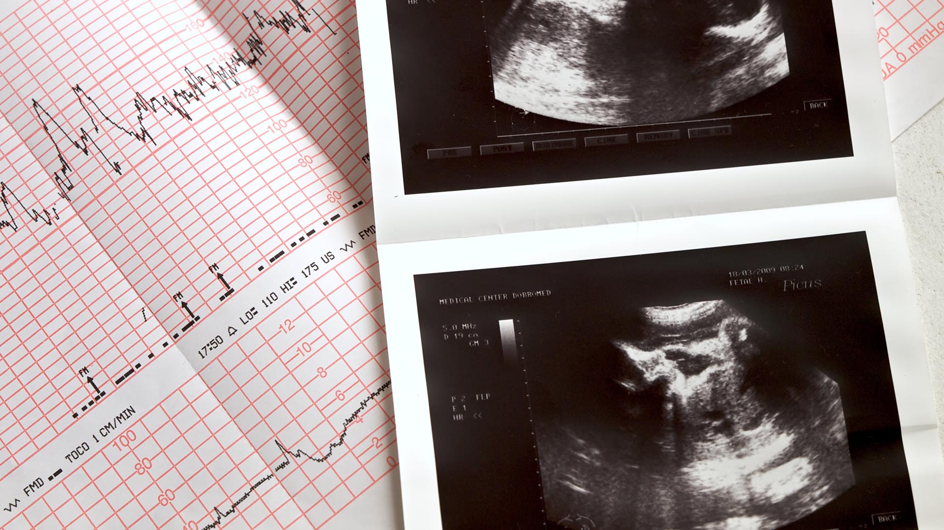 En la semana 20 de embarazo se indica un ecocardiograma fetal para detectar este tipo de patologías (Getty Images)