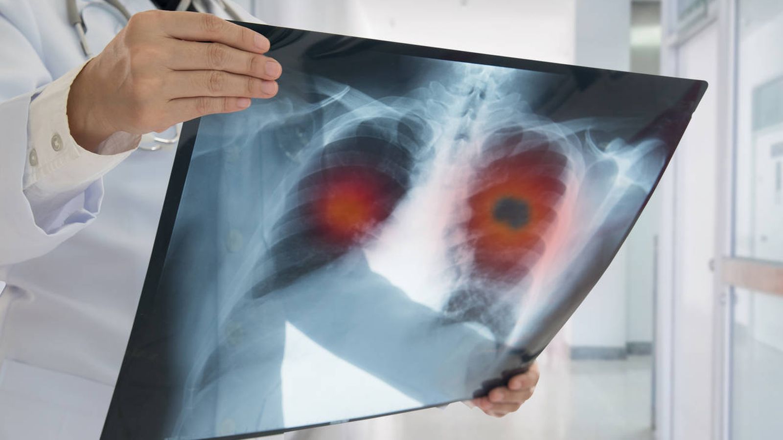 Les spécialistes ont cherché à comprendre la détérioration des poumons et des patients 1 an après avoir souffert du COVID-19 (photo : El Confidencial)