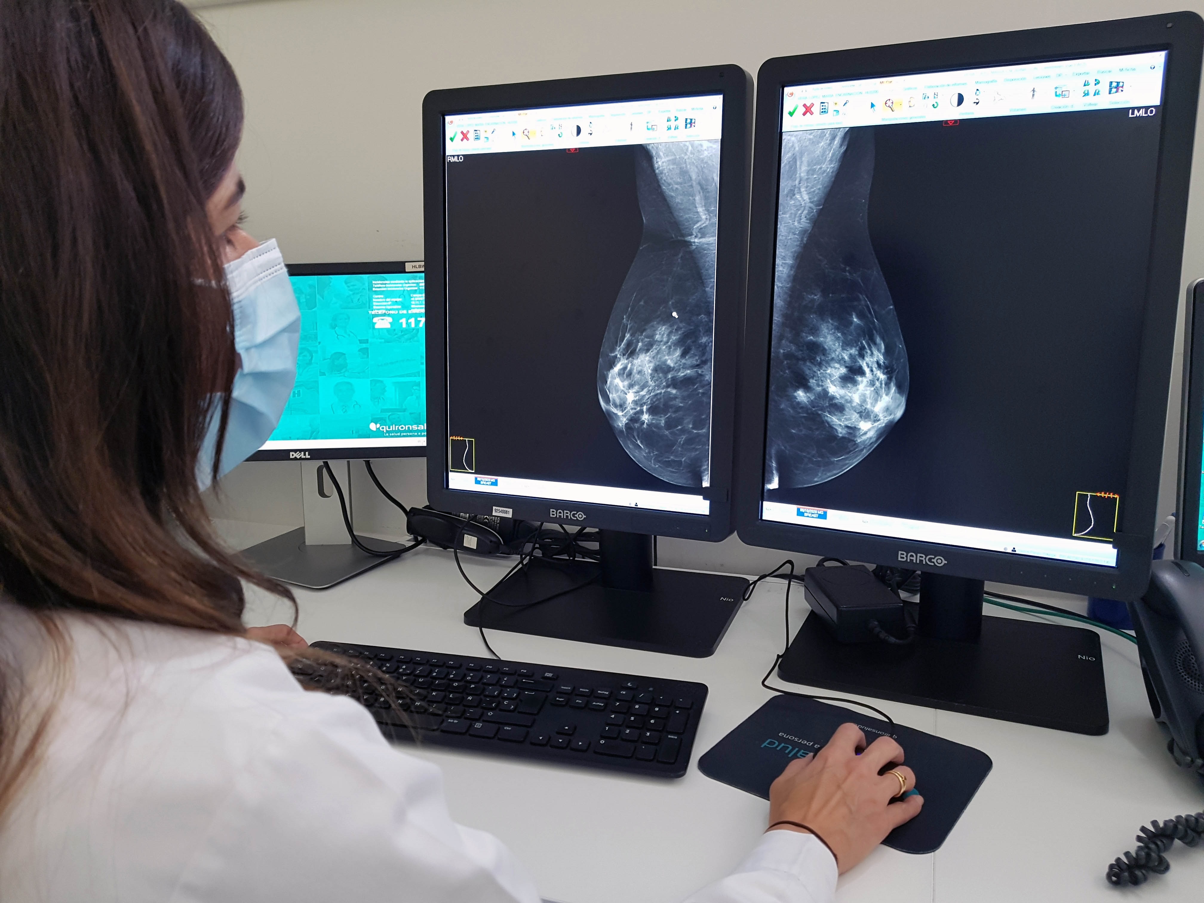 La aparición difusa de nódulos y la secreción por el pezón pueden ser señales de displasia mamaria (Europa Press)