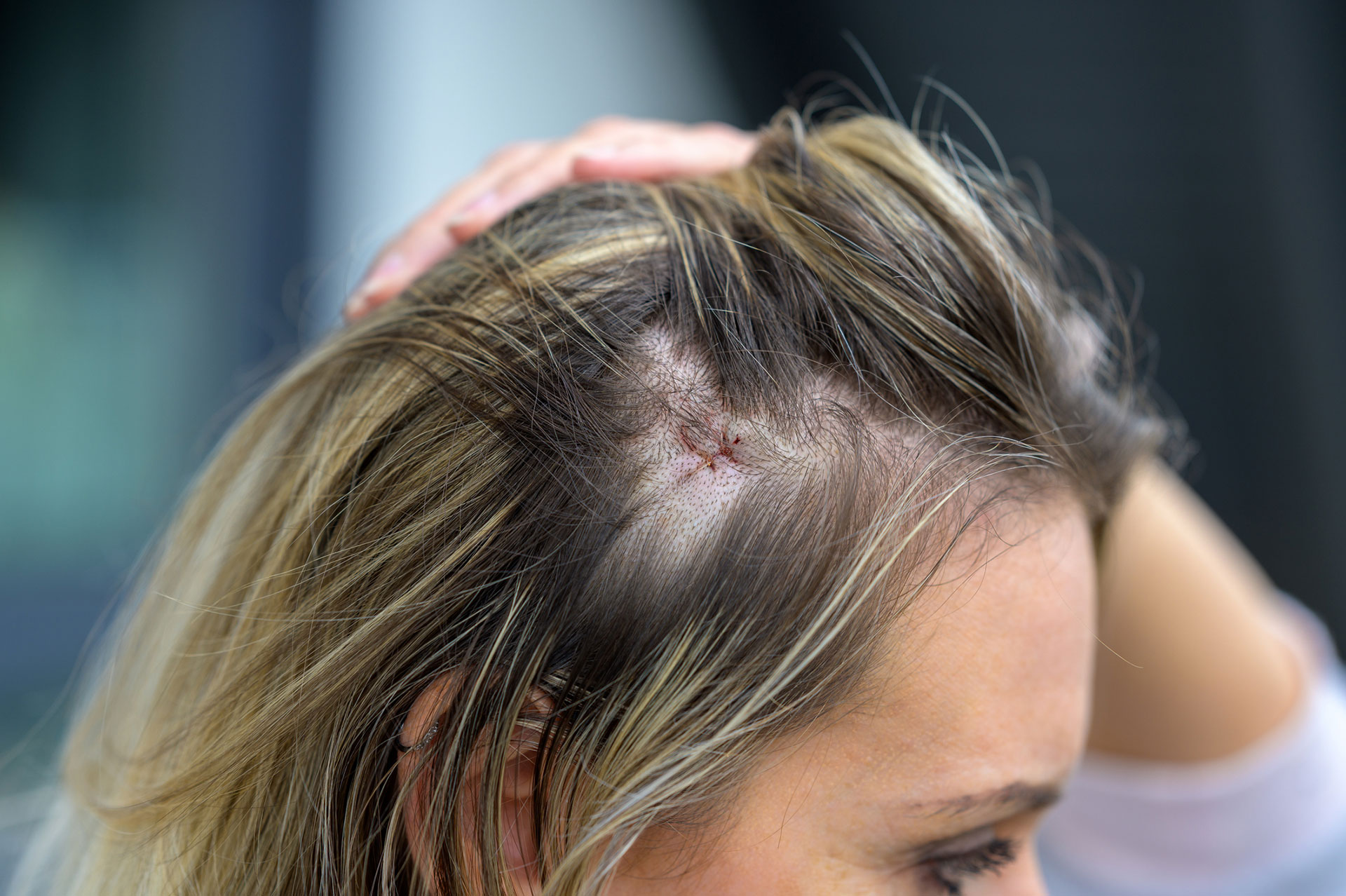 La alopecia cicatricial se da por las afecciones inflamatorias de la piel, como el acné, la foliculitis y otros trastornos