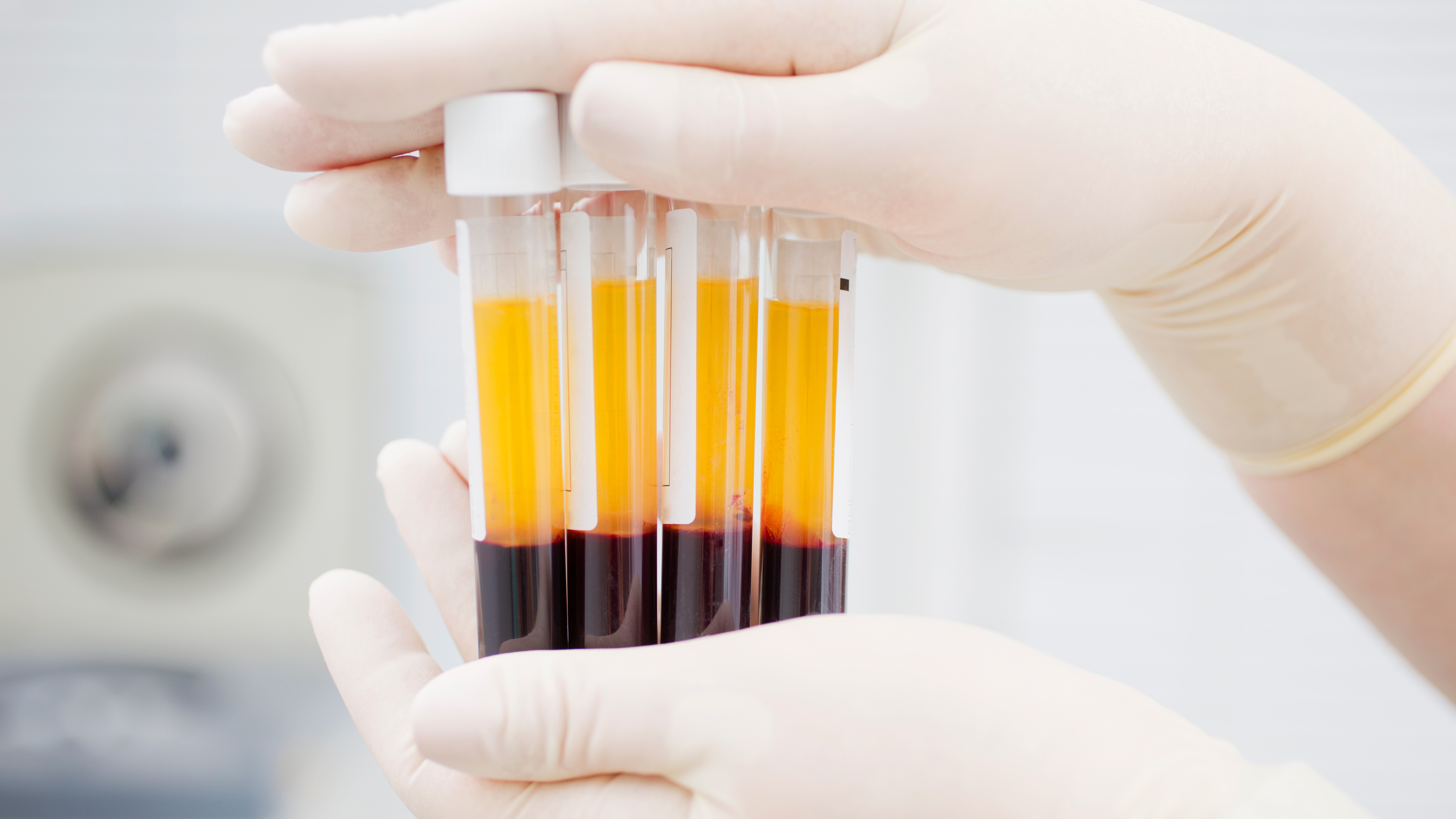 En diálogo con Infobae, la inmunóloga Lorena Regairaz, explicó: “el circuito empieza con la donación de plasma de personas que tuvieron COVID-19, y a los 14 días de haber negativizado la PCR, y a los 28 días del inicio de los síntomas" (Shutterstock)
