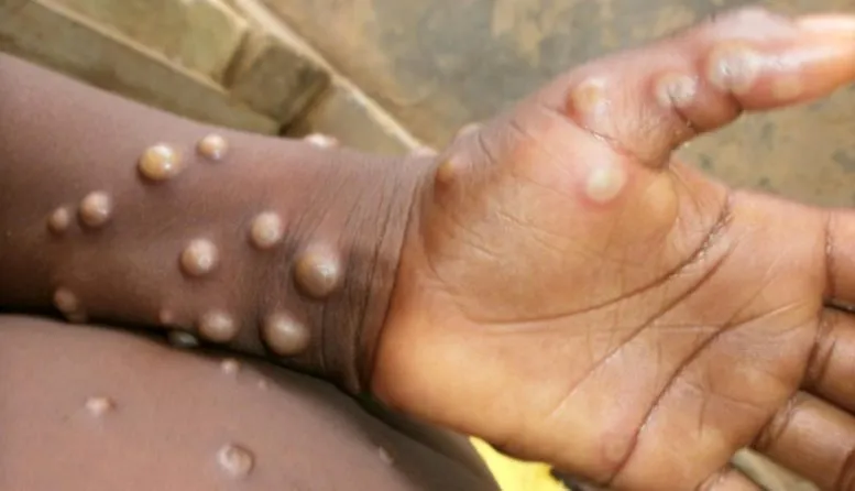 The first case of monkeypox appeared in the Democratic Republic of the Congo in 1970 (Photo: File)