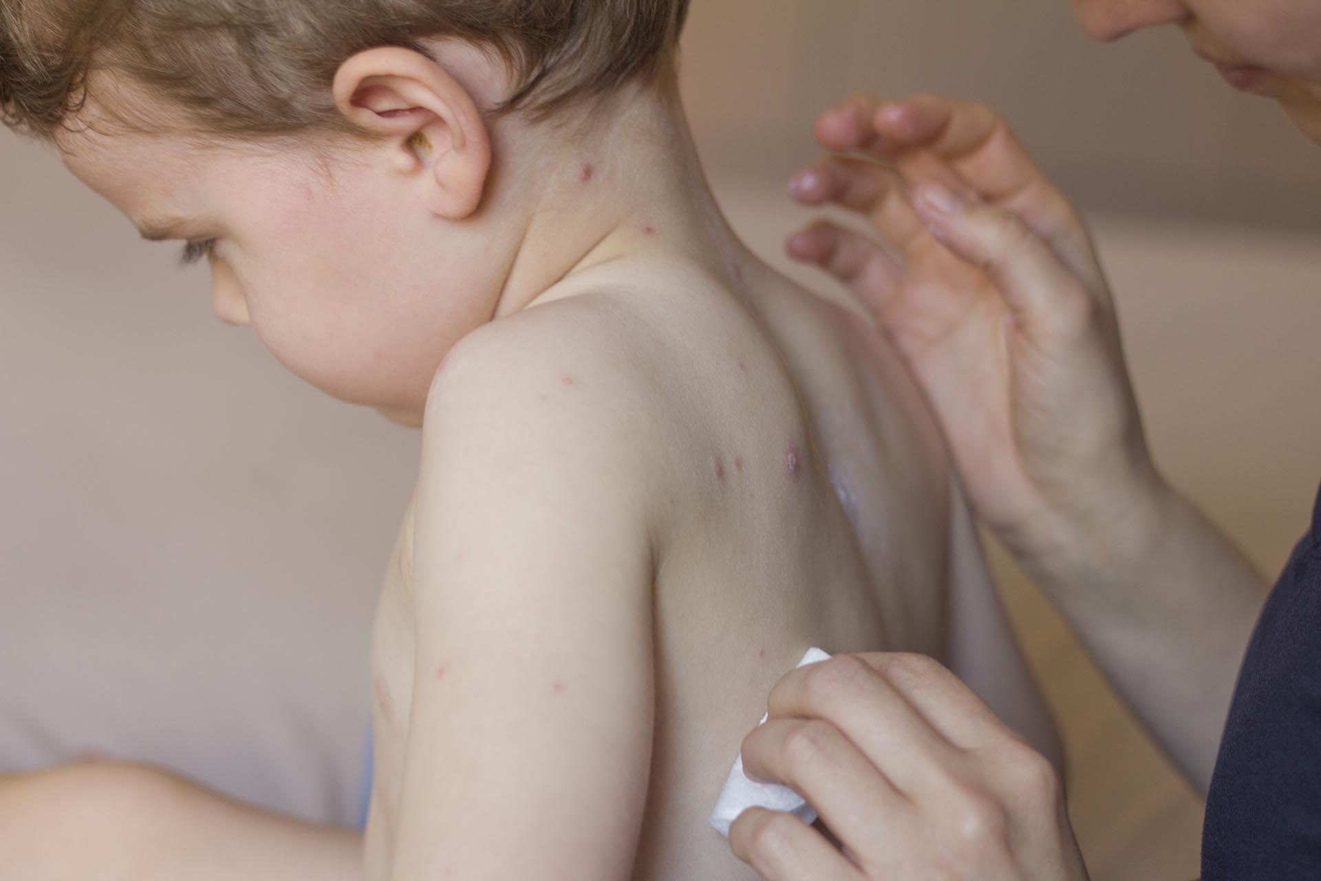 Unrecognizable mother applying medication on her two years old boy who has chickenpox.