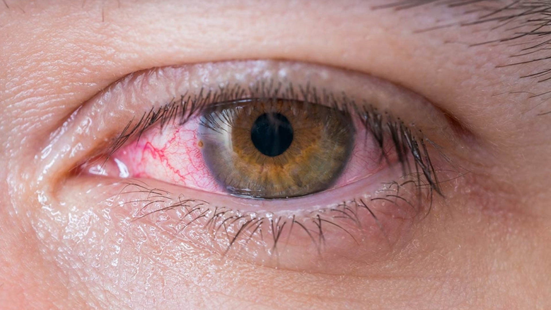 En los ojos, la vasculitis puede provocar que los ojos se vean rojos, piquen o ardan