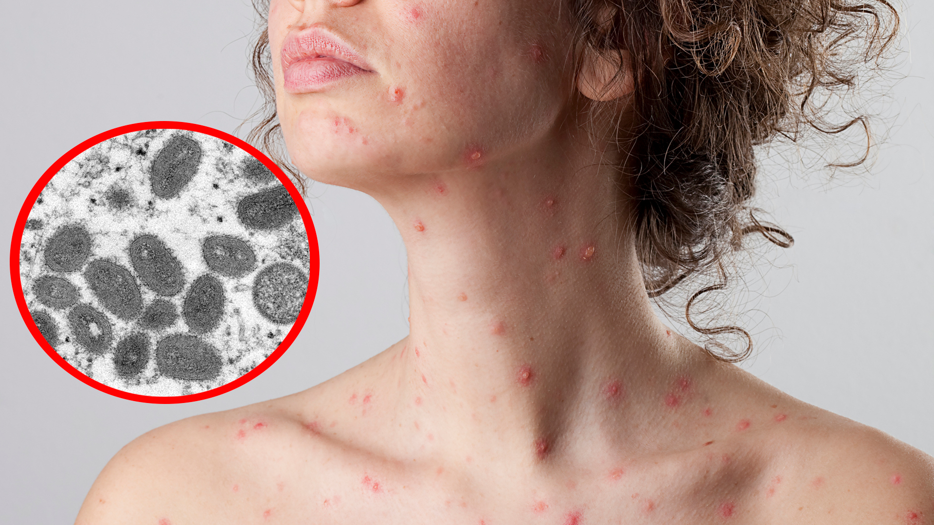 El contagio se produce por un contacto con la piel de un afectado o con las mucosas, el cual debe ser íntimo y prolongado