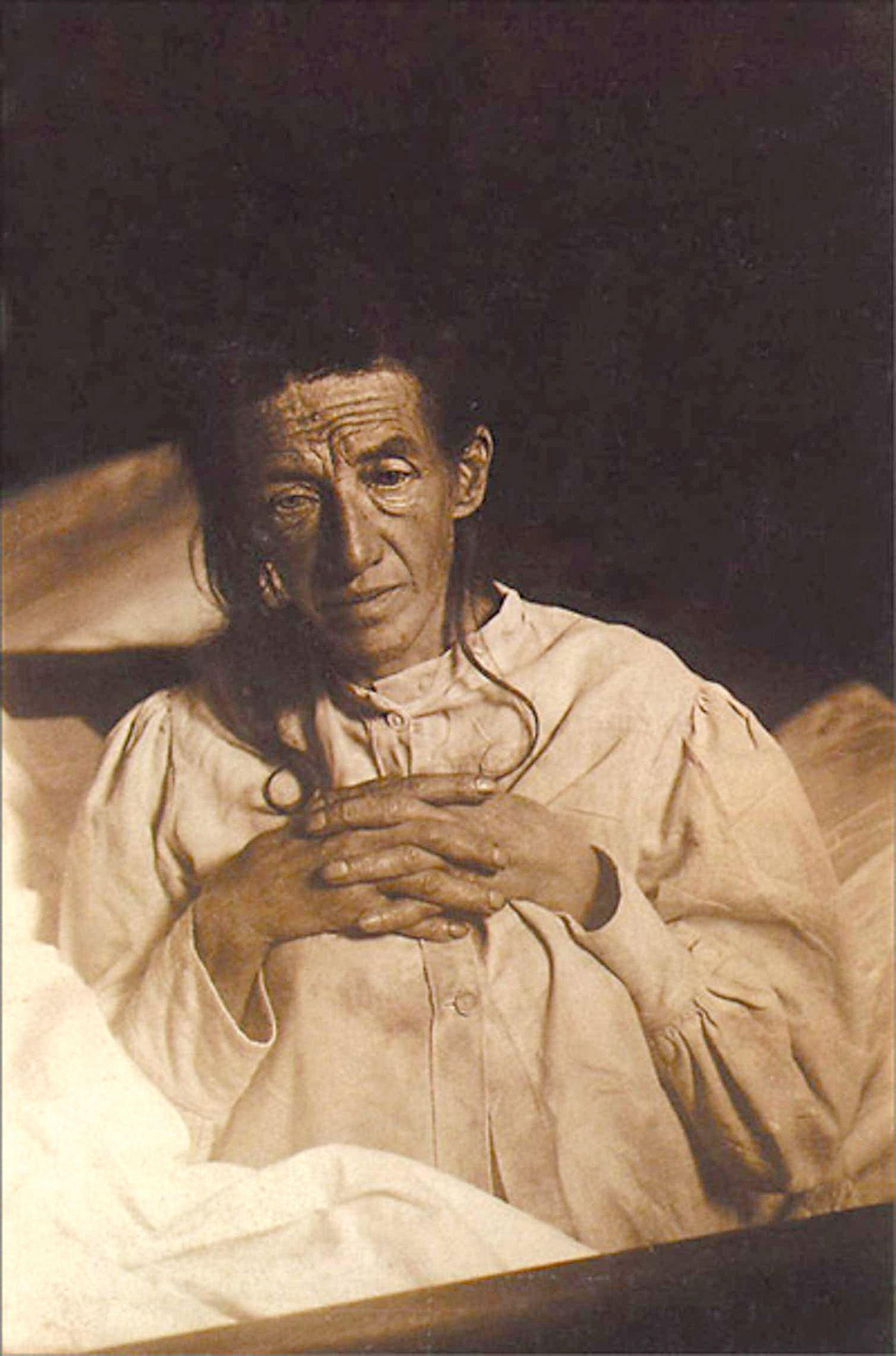 Auguste Deter (1850 – 1906), la paciente alemana que estudió el doctor Alzheimer y se convirtió en la primer en ser diagnosticada con este mal (The Grosby Group)