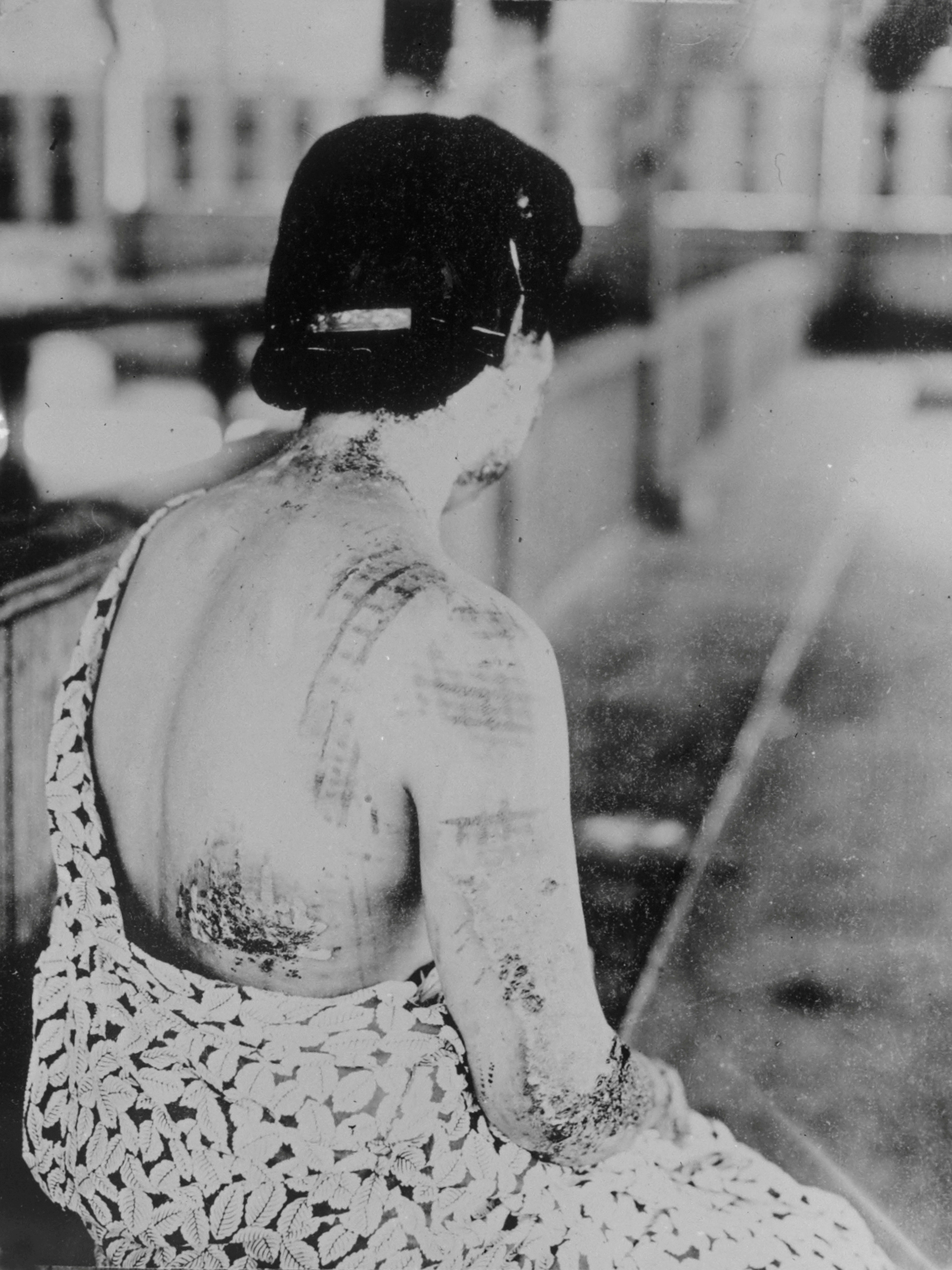 Una mujer es tratada de las quemaduras causadas por la bomba atómica en Nagasaki (Department of Energy/Lawrence Berkeley National Laboratory/REUTERS)