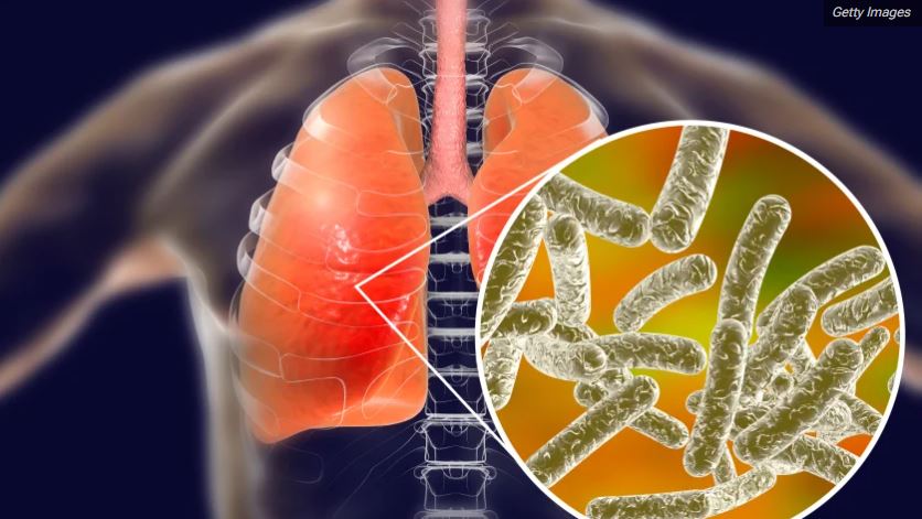 Los gérmenes acumulados en los filtros sucios del aire acondicionado cuando no hay un mantenimiento adecuado, pueden causar enfermedades respiratorias