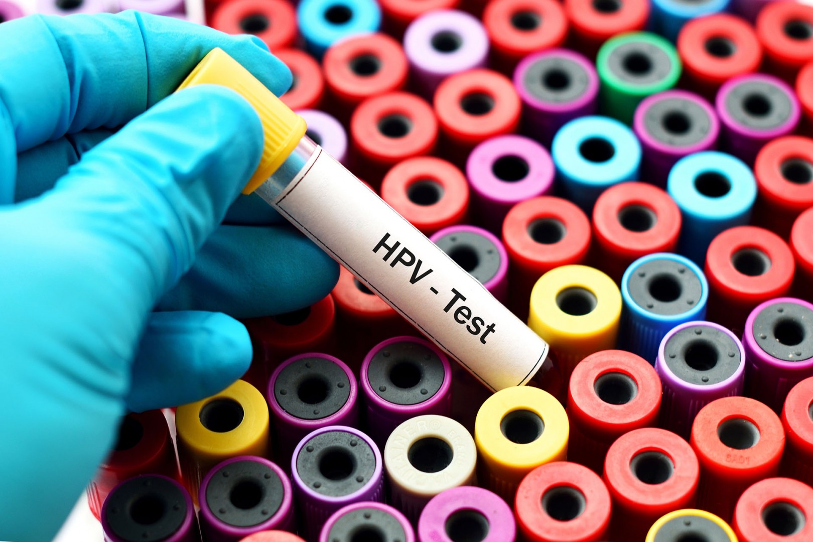 Hay un grupo de tumores orofaríngeos relacionados con el virus del papiloma humano (HPV) que están incrementando el número en el último tiempo (Getty Images)