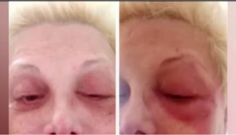 Así tenía el rostro Carmen Barbieri por un herpes zoster en 2020 (Captura TV)