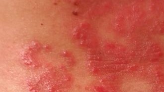 Algunos signos que manifiesta la piel como las erupciones pueden indicar reacciones alérgicas o pueden ser provocadas por el calor (Pixabay)