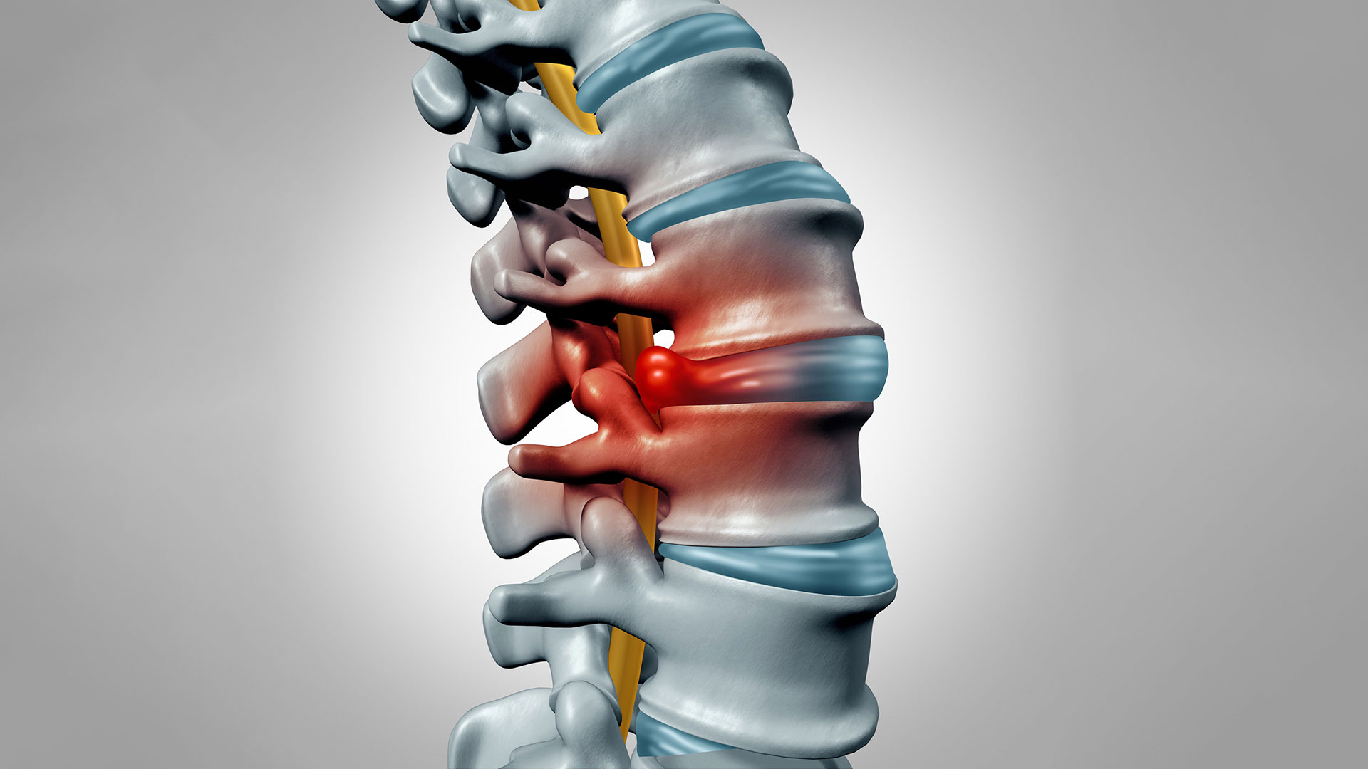 El dolor radicular está asociado a la presión sobre los nervios y puede extenderse desde la espalda hacia otras partes del cuerpo