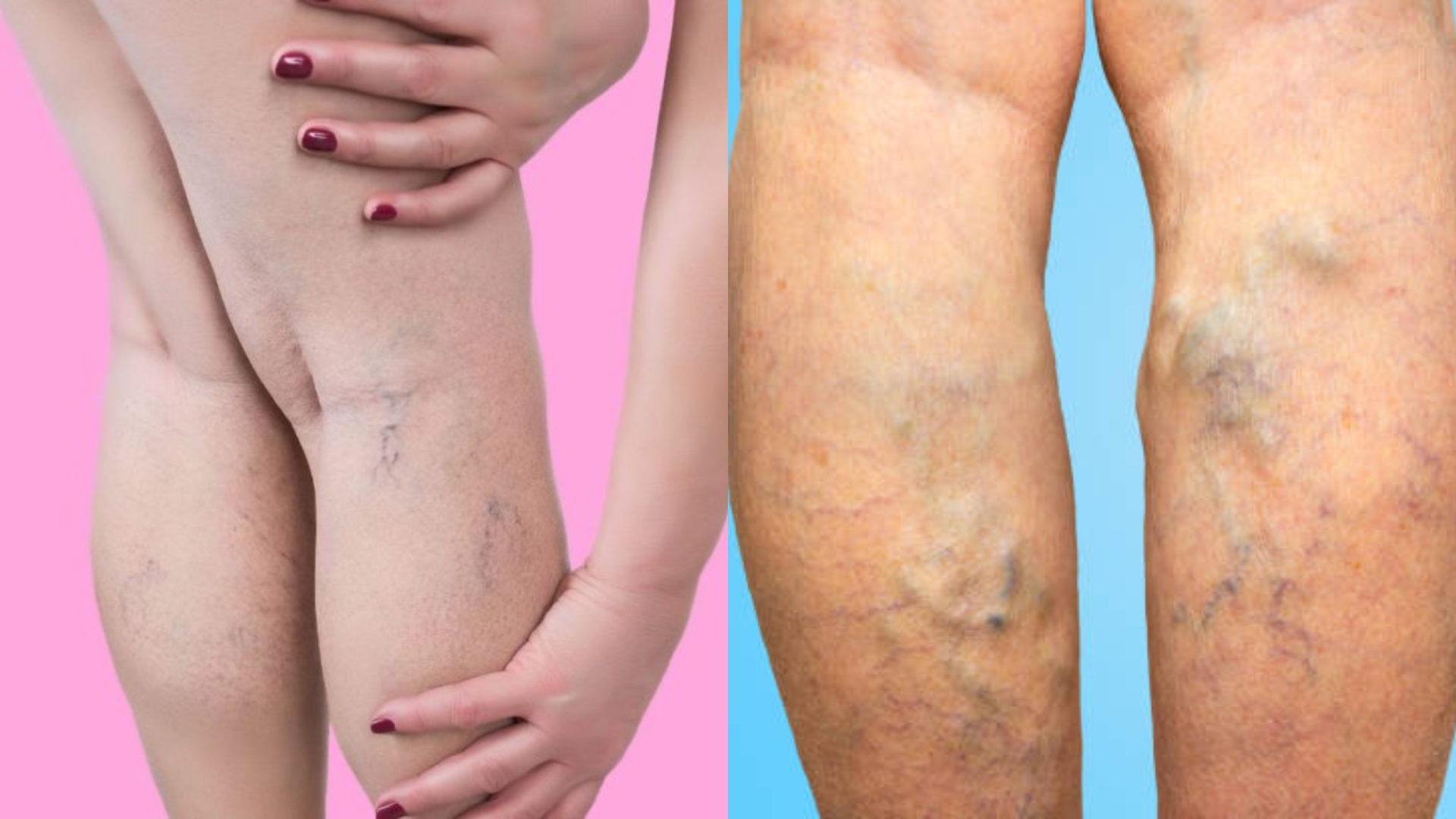 El aceite esencial ideal para eliminar varices, 'arañitas' y venas varicosas que es económico y fácil de conseguir - Infobae