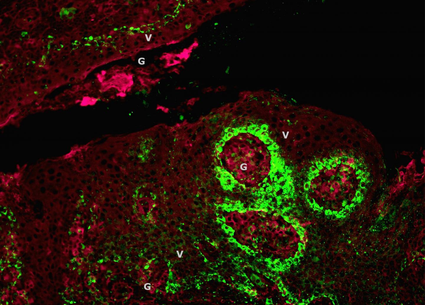 El Virus del Papiloma Humano (VPH) está generando un aumento de casos de cáncer bucal en jóvenes de entre 18 y 30 años en México
(CRÉDITO: Katherine Rieth. M.D)