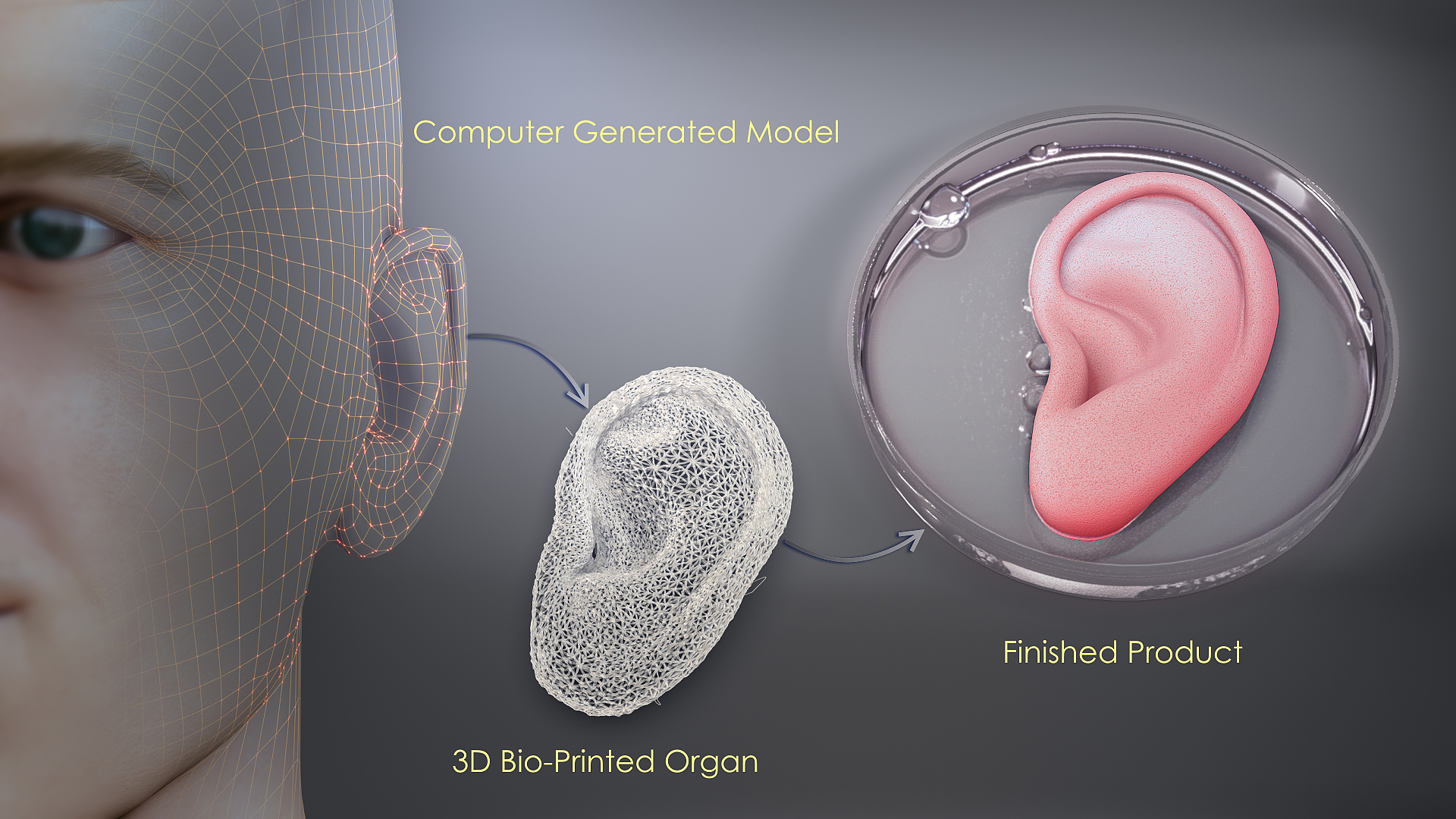 El implante de oreja, hecho de una pequeña gota de células extraídas de la oreja deforme de la mujer, parece ser el primer ejemplo conocido de un implante impreso en 3D hecho de tejidos vivos. (3DBio Therapeutics)