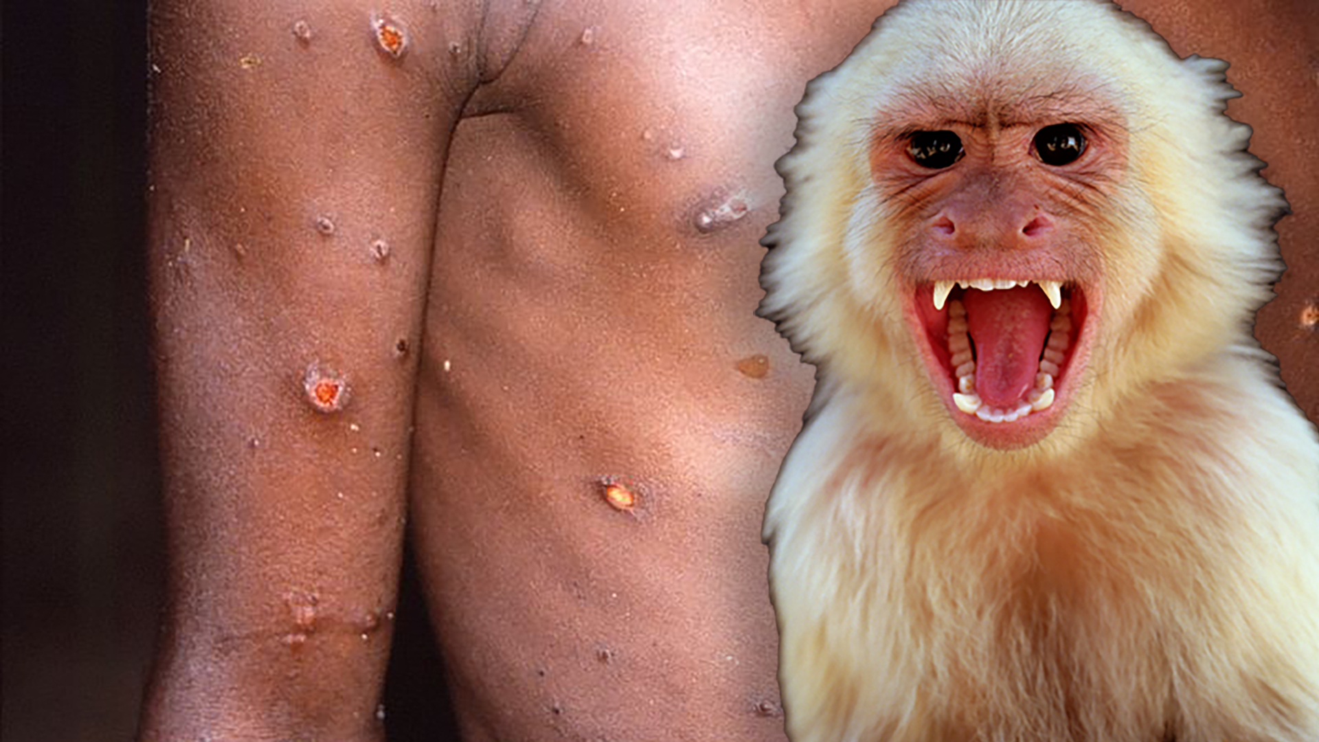 Viruela del mono: en el Reino Unido podría haber transmisión local, advirtió la OMS