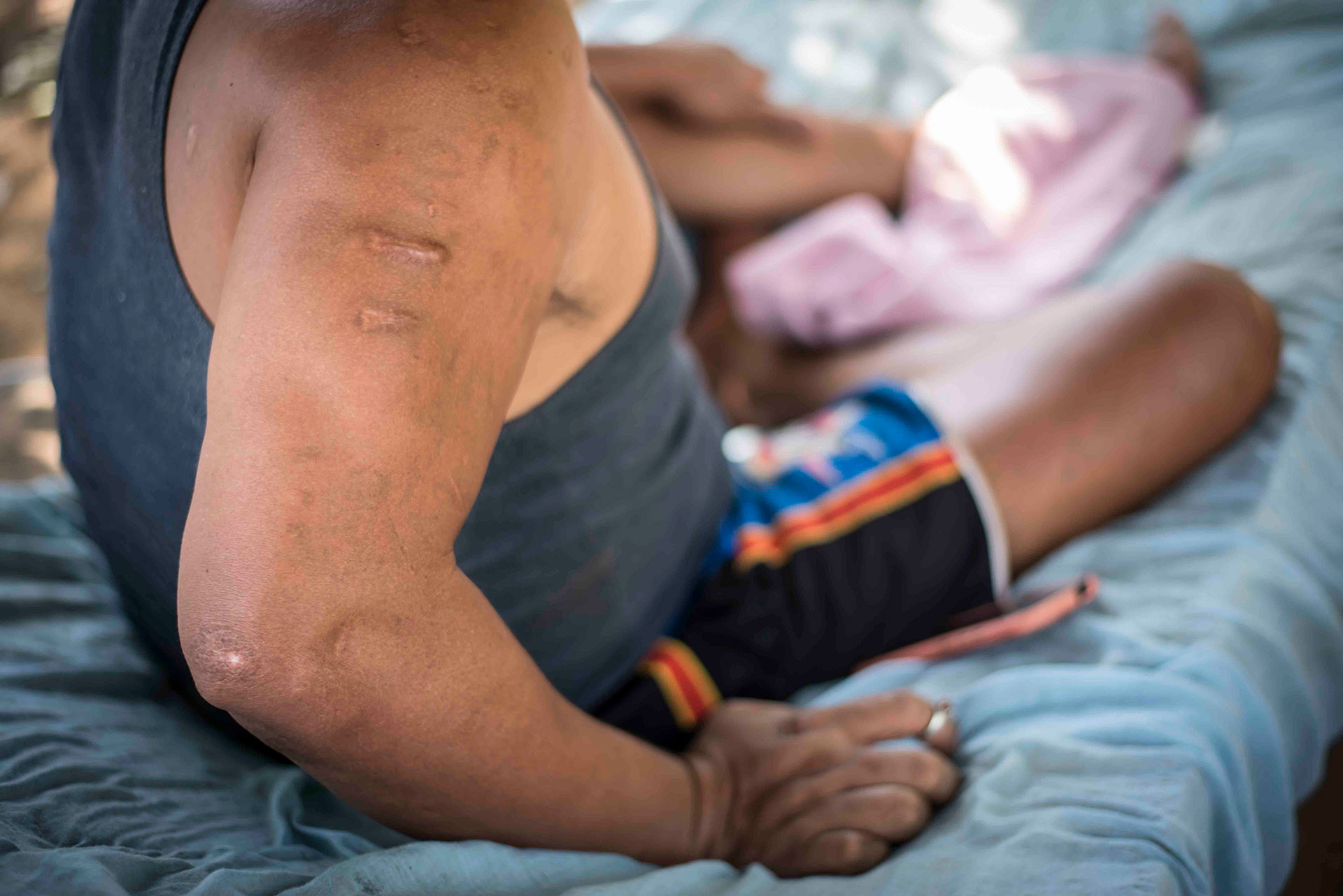Este campesino todavía tiene incrustados 10 perdigones de escopeta en su brazo derecho y parte de su espalda. Foto: Óscar Navarrete