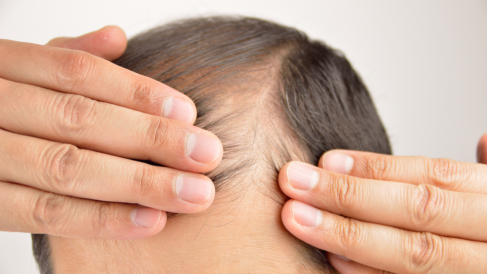 Caída pelo: cuándo preocuparse y qué tratamientos existen Infobae